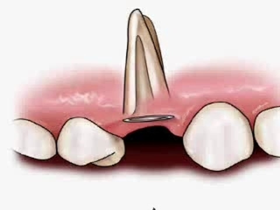 Inlay-core - Vidéo Dailymotion