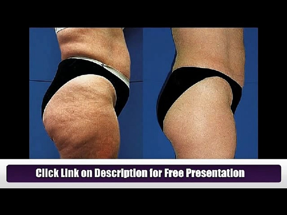 How to Get Rid of Cellulite on Thighs Fast & Naturally