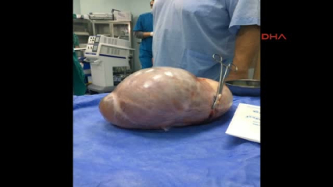 Kocaeli Karnından 5 Kilo 650 Gram Kist Çıktı