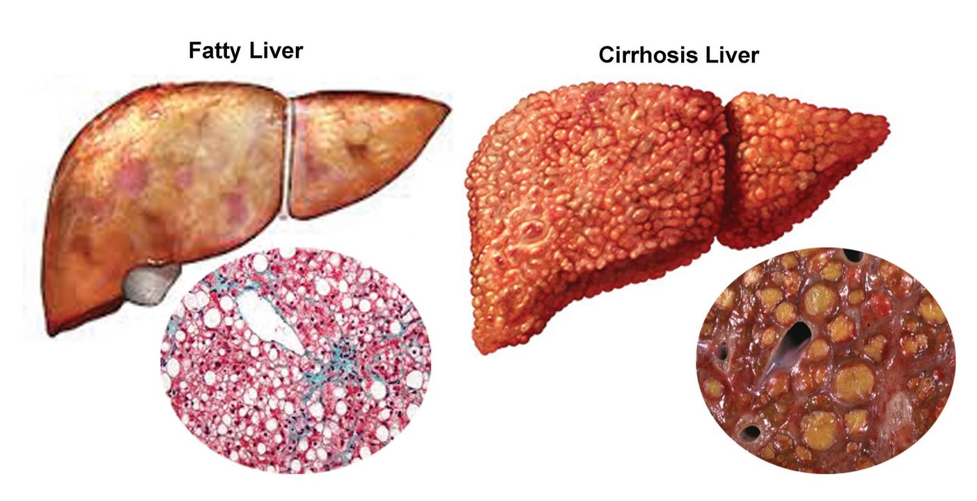 Natural Remedies To Reverse Fatty Liver Disease