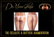 Cellulite and buttock augmentation