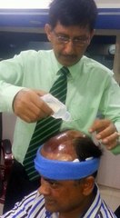 How To Apply Minoxidil On Hair Transplanted Area