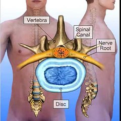 Lumbar Spinal Stenosis Treatment in New York