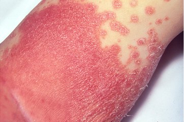 Bacterial Skin Infections