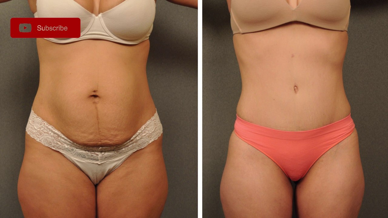 How to Remove (Lose Weight) tummy ( belly fat)? / Natural Master No.1