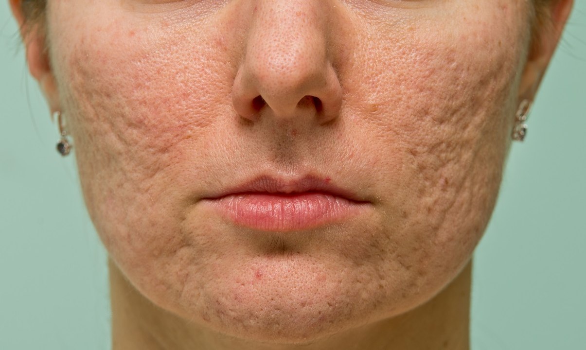 How To Make Acne Scars Disappear Fast