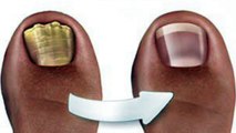 Thanks for sharing Alice! 5 home remedies to combat fungus toenails
