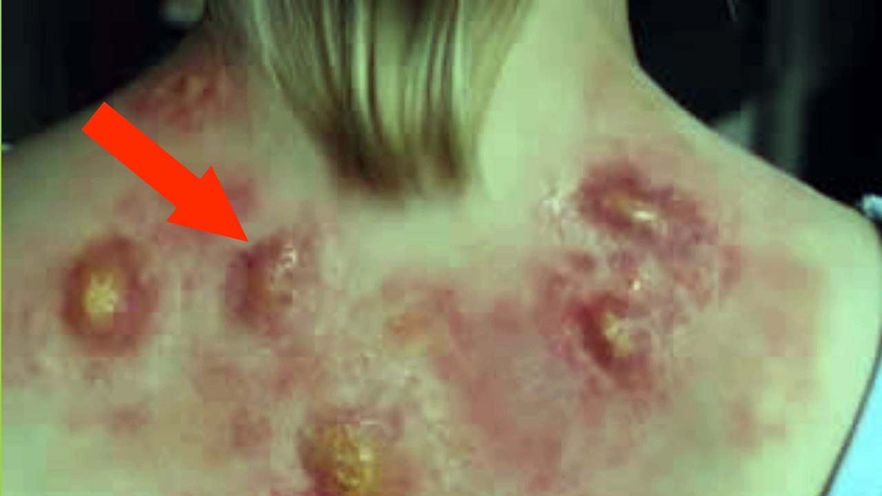 This home remedy looks disgusting, but it actually works! (ONION FOR BOILS)