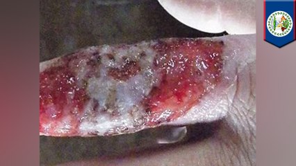 Man comes back from Belize with nasty flesh-eating parasite