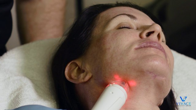 1 - Close up of Vivace RF Microneedling System Face Treatment