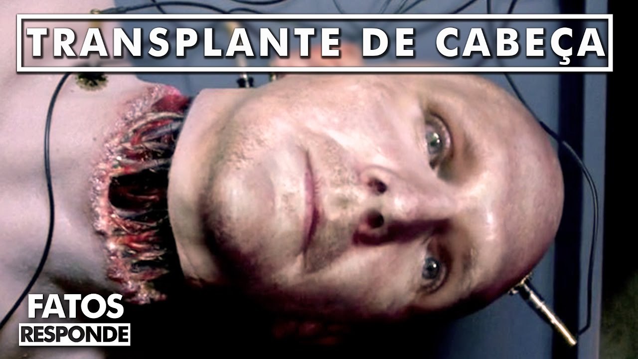 Transplante de cabeça acontecerá em 2017