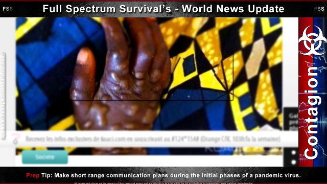 MonkeyPox Outbreak - Body Lesions - Earth Crust Weakness - FSS World News Update