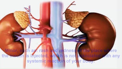 What Is Diabetes ► How To Cure Diabetes Without Medicine Naturally ► SHOCKING TRICK ► CERAGEM