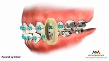 Sabe como funciona um aparelho dentário? Então veja como funciona!