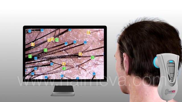 En Yeni Saç Ekimi Tekniği - DHI Saç Ekimi