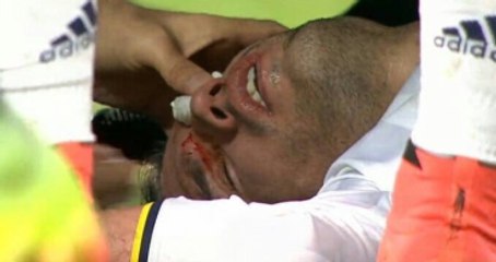 Robin Van Persie, Yüzüne Aldığı Darbe Nedeniyle Sakatlandı ve Oyundan Çıktı