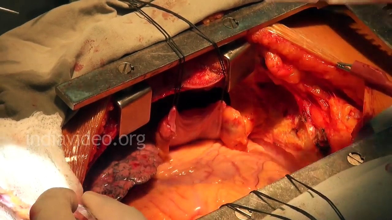 Open Heart Surgery Video (Live Heart Beating) _ India Video