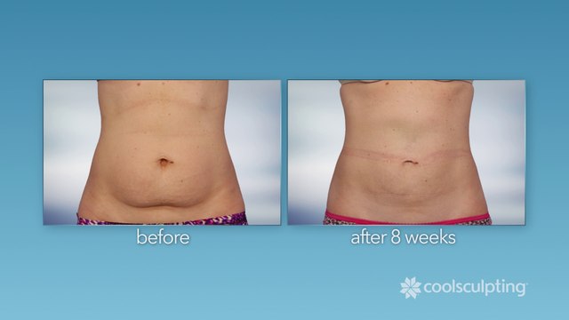 Coolsculpting - Eliminate stubborn fat without surgery | Fat-Freezing Fat Reduction Procedure | Dansys Medical Group