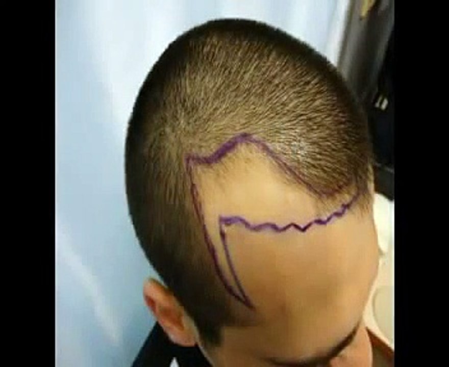 Op. Dr. Zekeriya KUL - Haartransplantation 1600 Greft