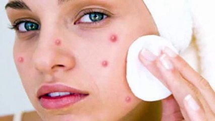 How to Remove Pimples from Face