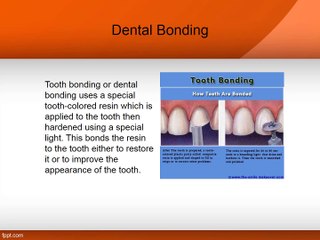 Dental Bonding Cost in Cosmetic Dentistry