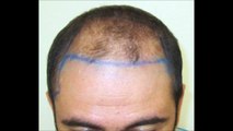 Op. Dr. Zekeriya KUL - Hair transplantation Needle Implantation Technique 3500 Greft