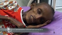 ข่าวช่องวัน | สาวเยเมนรับการรักษาตัวเพราะขาดอาหาร | ช่อง one31