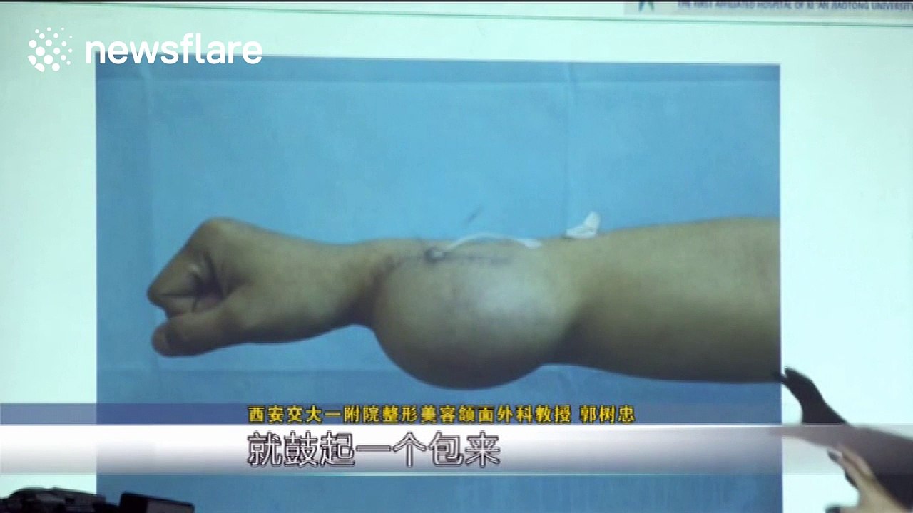 Doctors grow ear on man's arm after he lost an ear in an accident