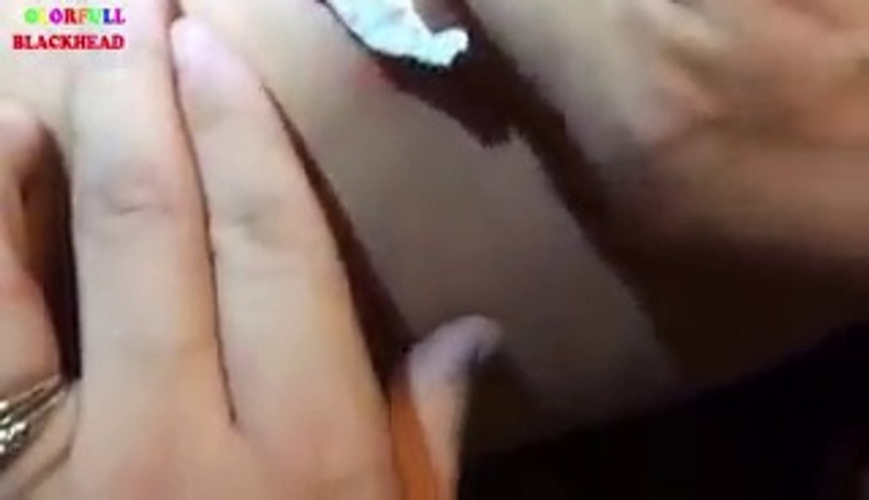 Il se retrouve avec un trou dans le dos après que sa copine lui aie percé un bouton ! Ecoeurant !