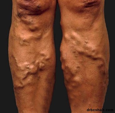 How to Get Rid of Varicose Veins on Legs