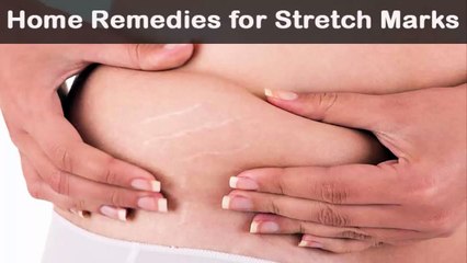 Home Remedies for Stretch Marks