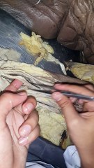 Upper Limb flexor compartment PGIMS rohtak