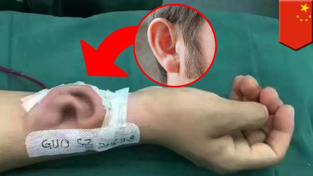 Chinese hospital grows man’s new ear on his forearm