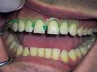 Metoda e re e rregullimit te dhembeve per te siguruar per 100 vite