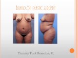 Tummy Tuck/Abdominoplasty: Brandon Plastic Surgery- Brandon, FL