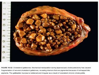 Risk Factors For Developing Gallstones