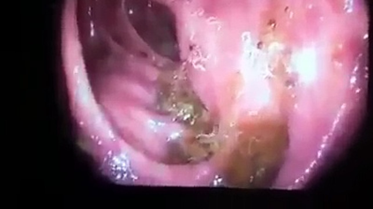 Voici l'intestin d'une personne qui mange de la viande de porc