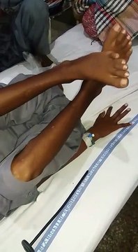 Wilson's Disease: Signs and Symptoms