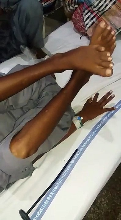 Wilson's Disease: Signs and Symptoms