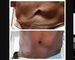 Tummy Tuck - Cellulite - Loose Skin After Weight Loss- Pregnancy