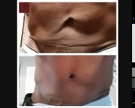 Tummy Tuck - Cellulite - Loose Skin After Weight Loss- Pregnancy