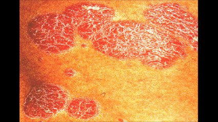 Tư vấn của bác sĩ về cách chữa bệnh nấm da đầu