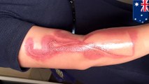 Pregnant mother suffers second degree burn after falling asleep on her iPhone 7
