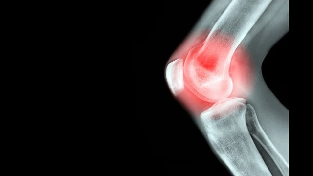 Treatment For Knee Pain in Clermont FL USA-ClermontKneePain