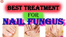 Best Treatment of Nail Fungas | Vinegar As a Toenail Fungus Treatment | Fast Cure For Toenail Fungus