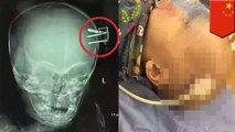 ベッドから落ちた2歳児の頭にプラグ刺さる　中国・広東省