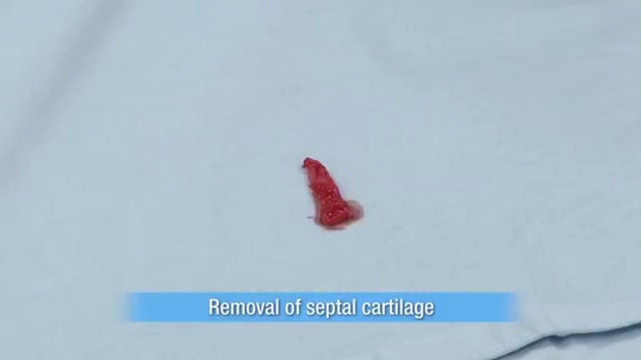 Burun Küçültme Ameliyatı Dailymotion Video