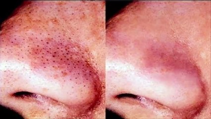 Do This To Remove Blackheads From The Nose At Home In 5 Minutes or Less!