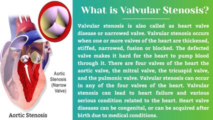 Explaining Valvular Stenosis: The Most Common Heart Disorder