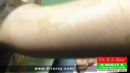 Ayurvedic Treatment for Psoriasis - Psoriasis Cure In Kerala